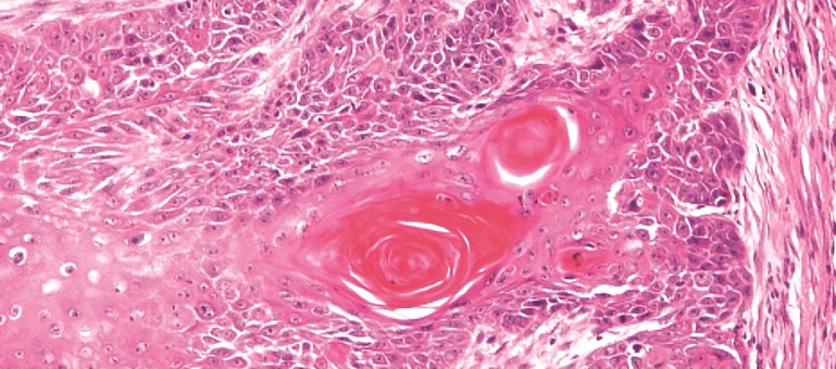 Early invasive squamous cell carcinoma